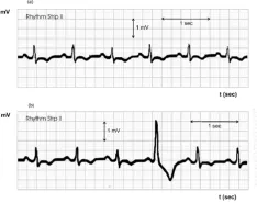 IMAGE 2: EKG chart for a human heart	