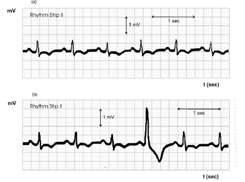 IMAGE 2: EKG chart for a human heart	