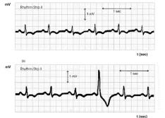 IMAGE 2: EKG chart for a human heart	